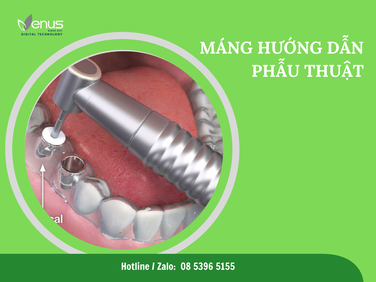 Máng hướng dẫn phẫu thuật