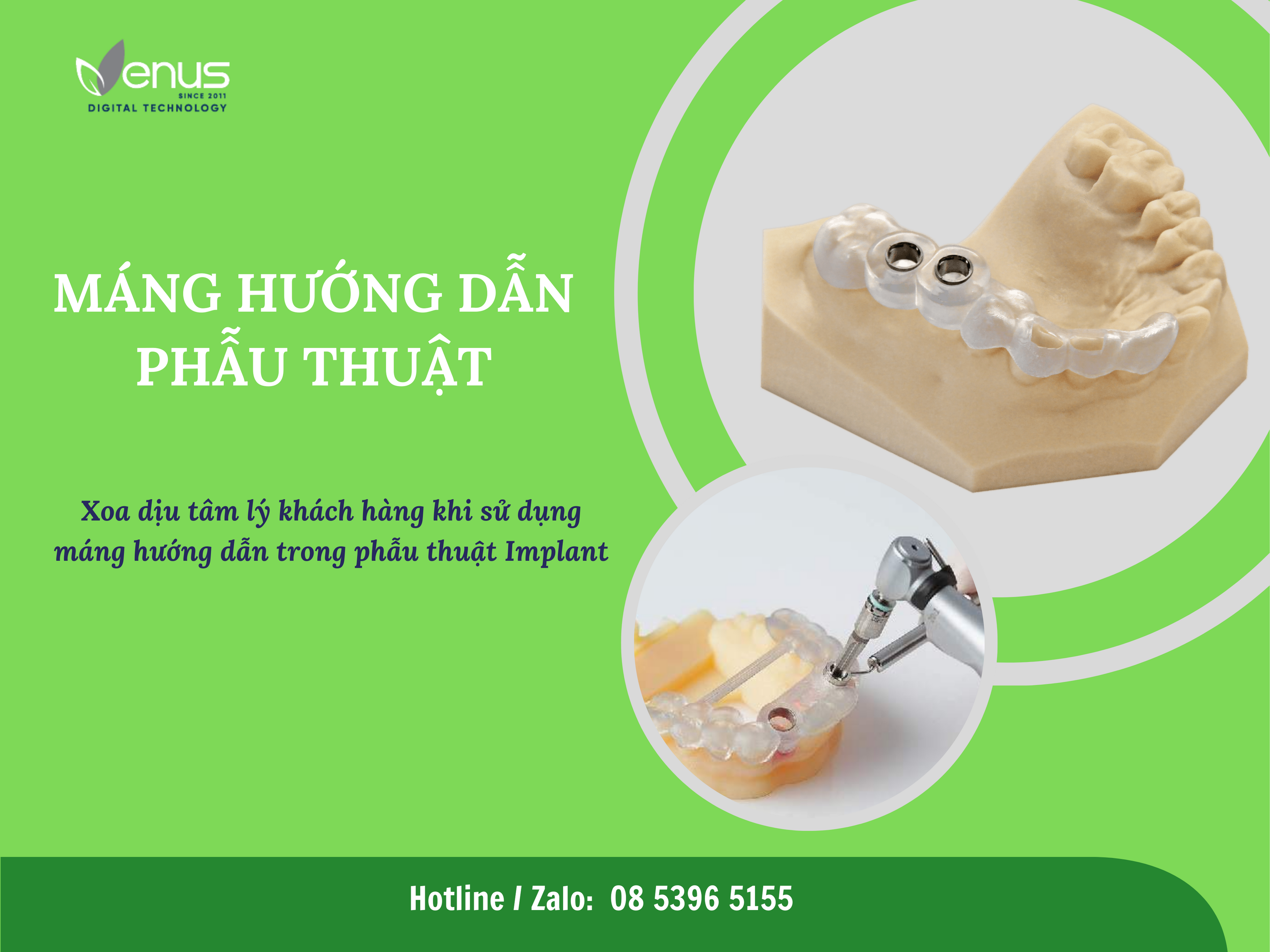 NHA KHOA KỸ THUẬT SỐ -MÁNG HƯỚNG DẪN PHẪU THUẬT LIỆU CÓ CẦN THIẾT?